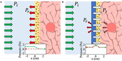 Non-Hermitian Complementary Acoustic Metamaterials for Imaging Through Skull With Imperfections